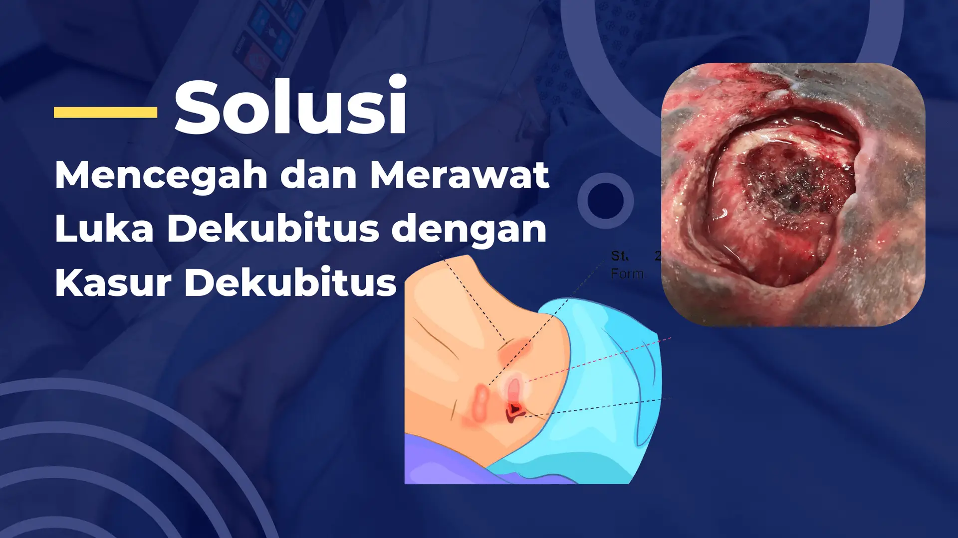 apa itu kasur dekubitus, cara memilih kasur dekubitus
