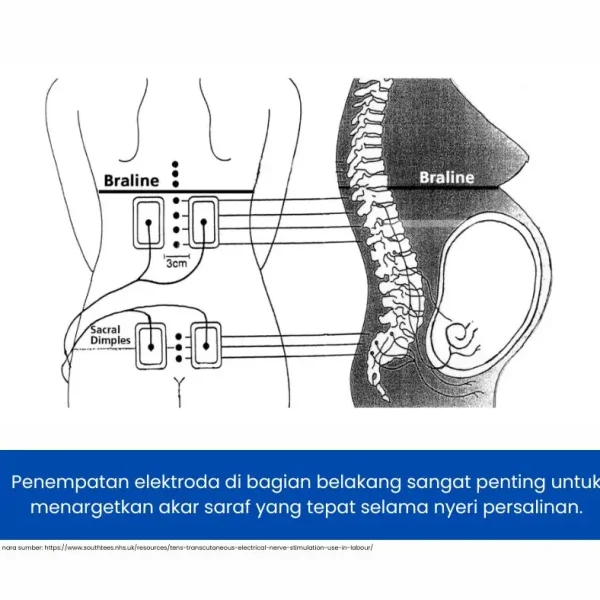 Penempatan elektroda tens unit yang tepat